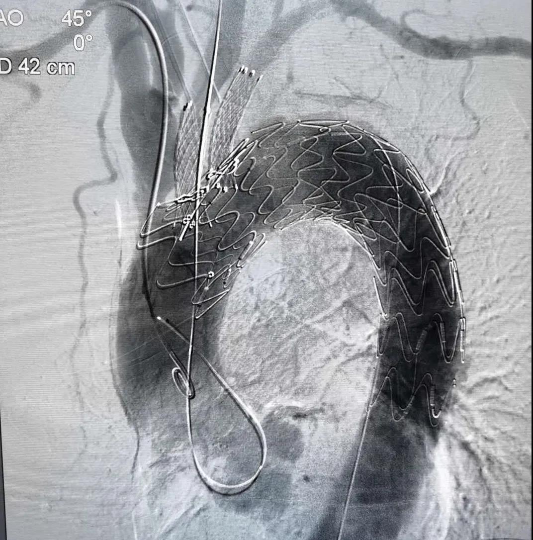 主动脉夹层支架植入术图片